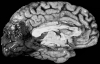 Posterior cerebral artery distribution infarct in a hyperbilirubinemic patient